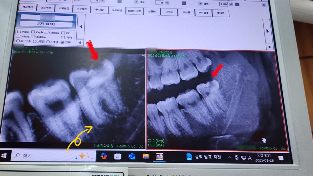 img of 예약 없이 당일 사랑니 발치 후기: xray부터 사랑니 뽑기까지 원데이 올인원 패키지